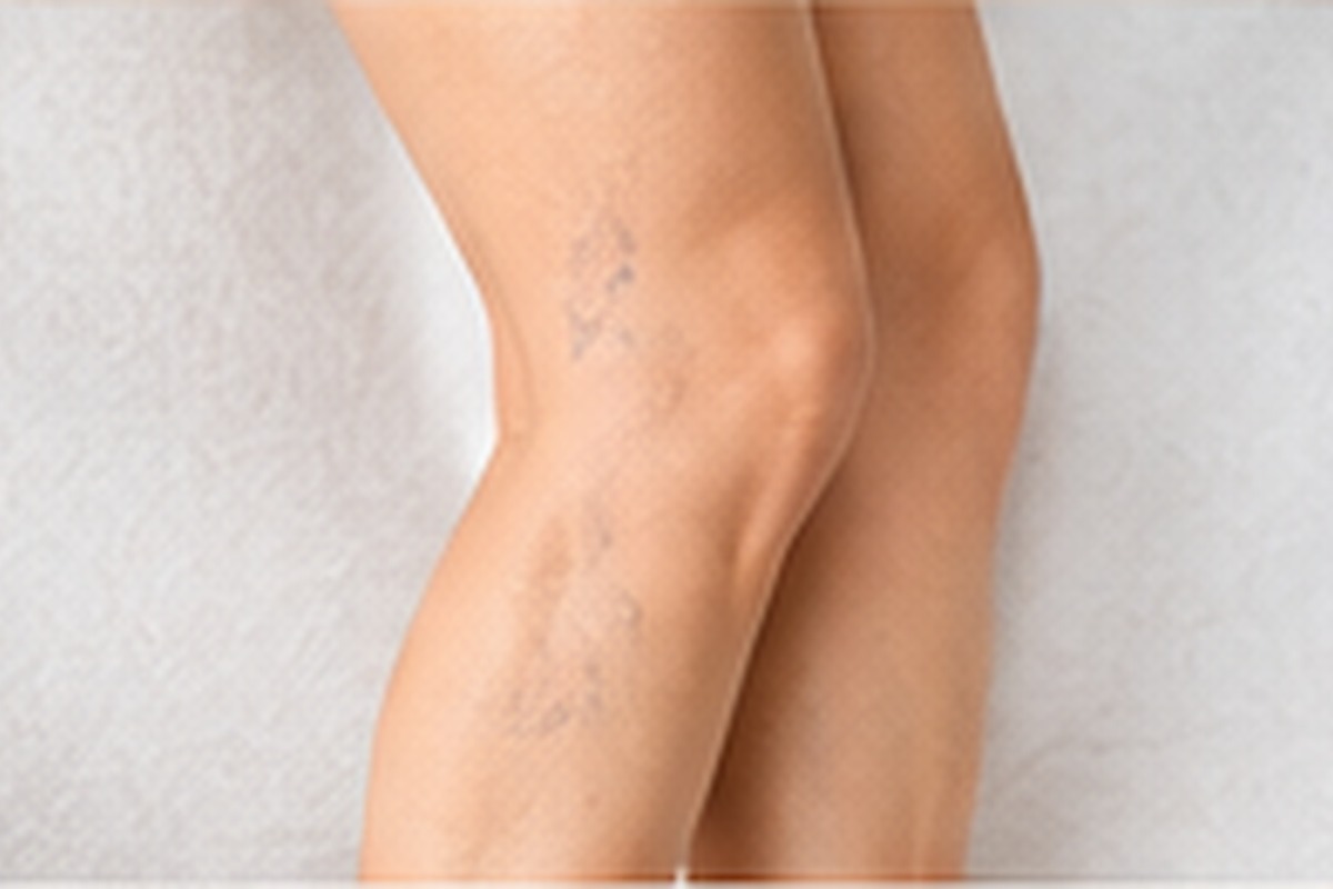 Illustrative leg and vascular-care consultation